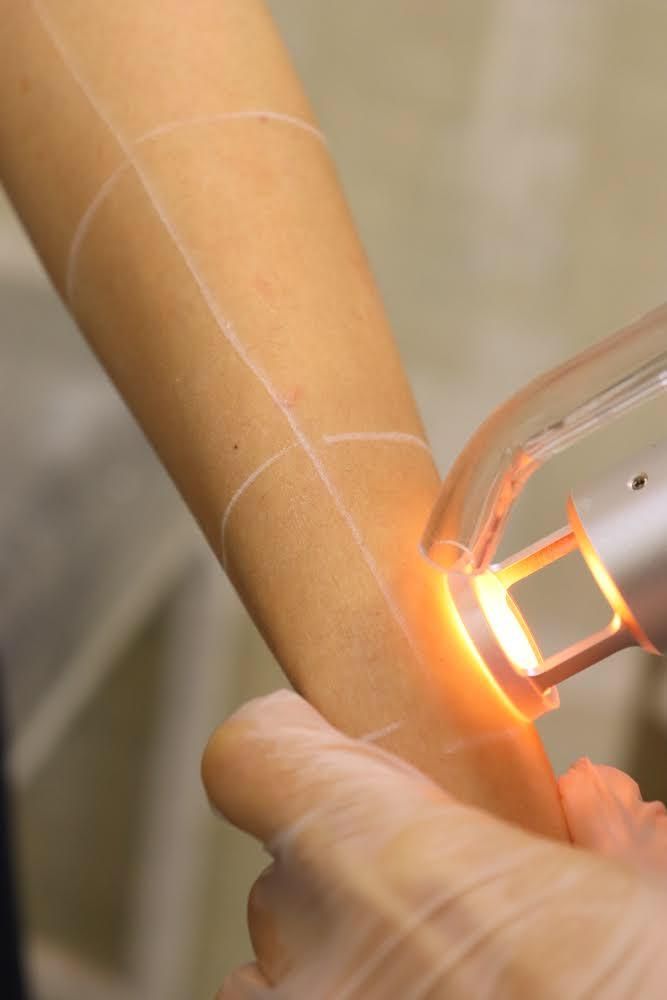 Underarms laser hair removal